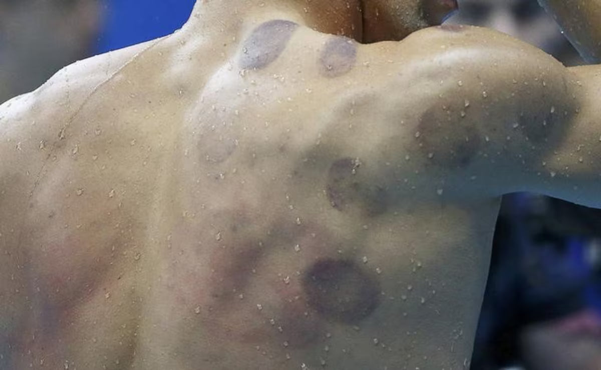 Estus Cupping Device